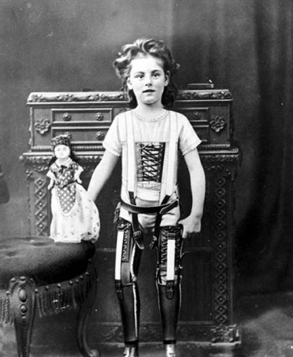 5.-A-child-with-artificial-legs-1898